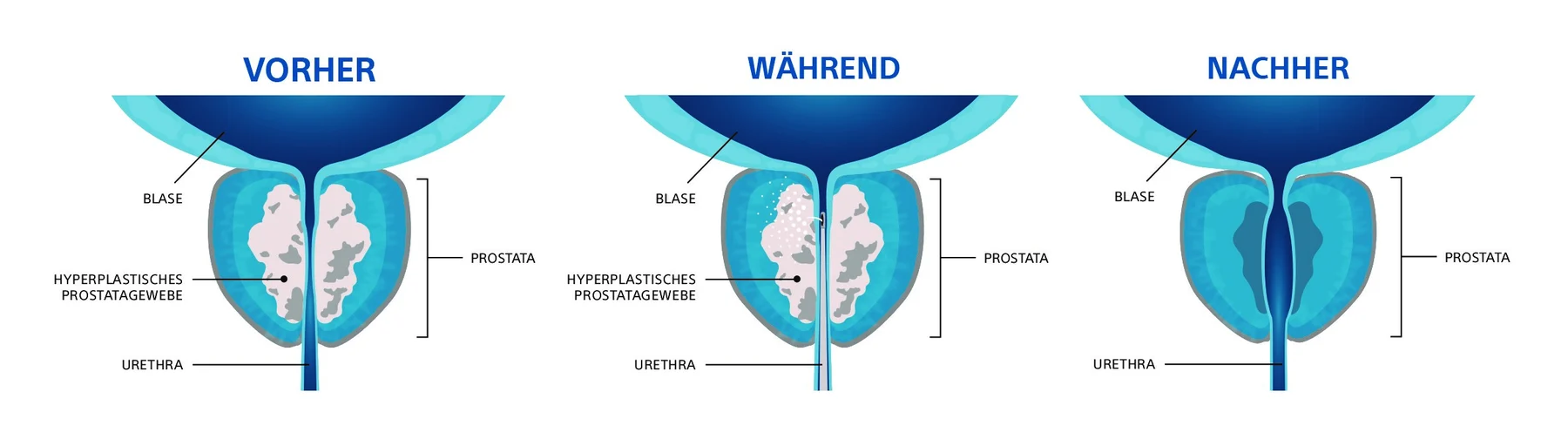 Rezūm-Wasserdampftherapie: Prostata vor, während und nach der Behandlung – das vergrößerte Prostatagewebe wird verkleinert, die Harnröhre erhält wieder mehr Platz